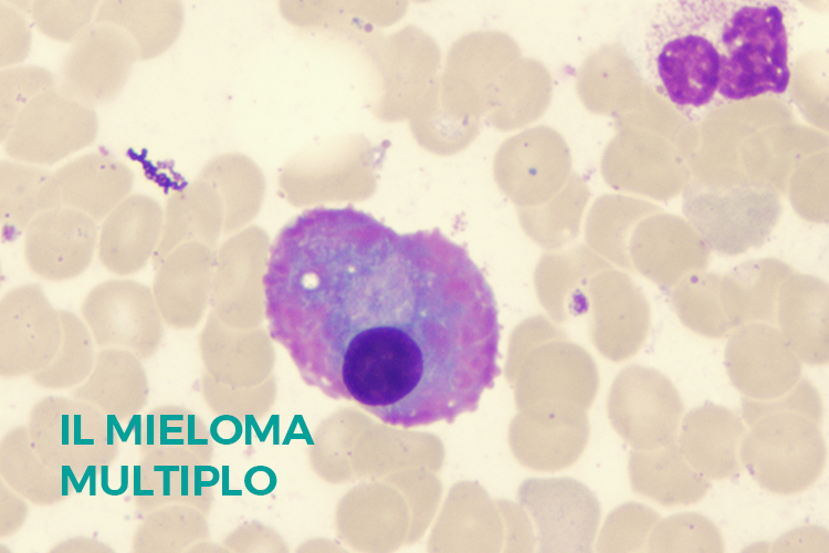 mieloma multiplo luca serra neurochirurgo